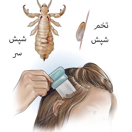 سم شپش کش مو و محیط پرمکترین مبارز قوی شپش ارسال رایگان